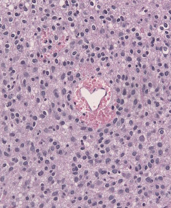 Everyone loves histology! (Image accessed on 3/18/18 from https://commons.wikimedia.org/wiki/File:Oligoastrocytoma_histology_HE.jpg)